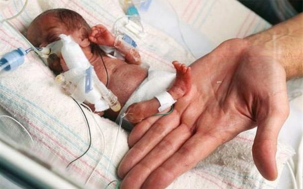 Miracle ! Meet World's Smallest Baby Emilia whose height is just 8.2 inch and weighs only 230 Grammes