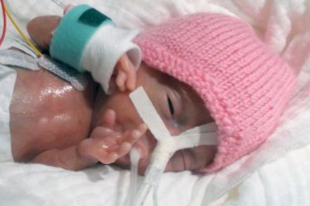 Miracle ! Meet World's Smallest Baby Emilia whose height is just 8.2 inch and weighs only 230 Grammes
