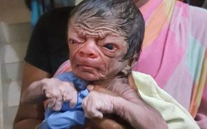 Can You Imagine of A New-Born Boy Who looks like an 80 Years old? Well then meet This Boy from Bangladesh