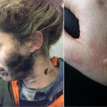 Headphone explosion: Woman’s face and hair burnt on plane
