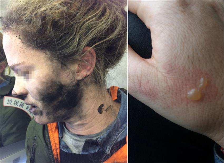 Headphone explosion: Woman’s face and hair burnt on plane